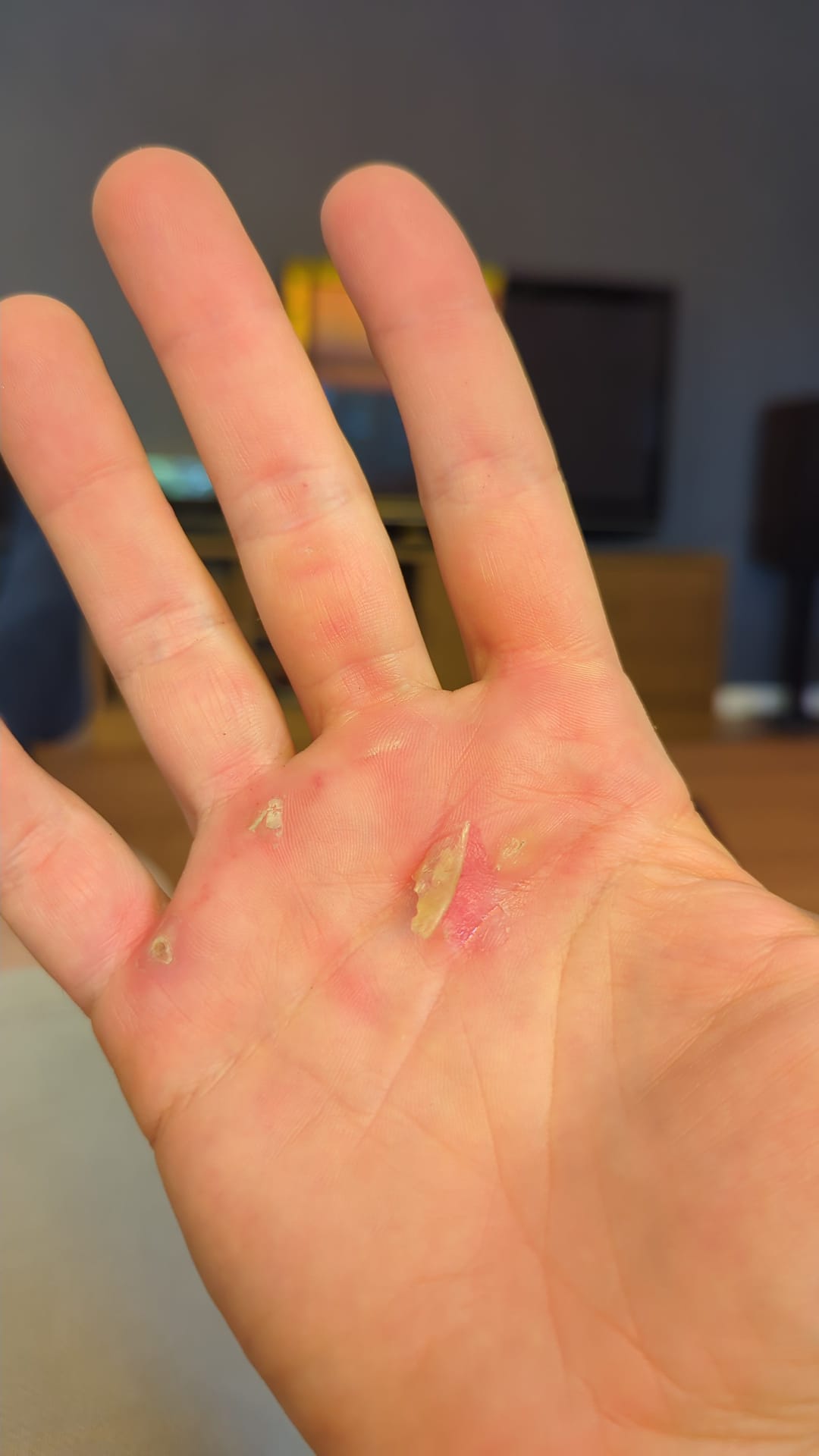 Cloques mains après 100 pull-ups WOD Murph CrossFit maniques grip protection